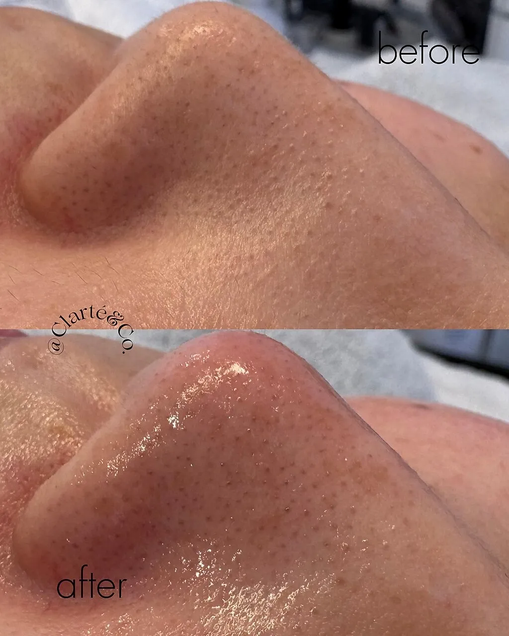 ハイドロ毛穴洗浄×ワックス(鼻)